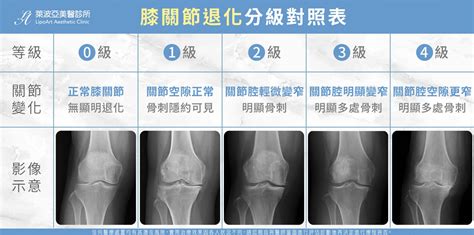 膝蓋長毛怎麼辦|膝蓋退化可以吃維骨力？骨科醫推「1招有效」膝蓋多。